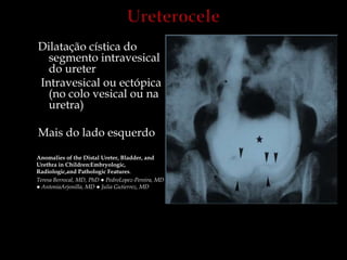 Dilatação cística do
segmento intravesical
do ureter
Intravesical ou ectópica
(no colo vesical ou na
uretra)
Mais do lado esquerdo
Anomalies of the Distal Ureter, Bladder, and
Urethra in Children:Embryologic,
Radiologic,and Pathologic Features.
Teresa Berrocal, MD, PhD ● PedroLopez-Pereira, MD
● AntoniaArjonilla, MD ● Julia Gutierrez, MD
 