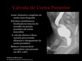 Lesão obstrutiva congênita da
uretra mais frequente
Estrutura membranosa,
localizada na mucosa do
assoalho da porção
prostática da uretra
masculina
A válvula obstrui o fluxo
urinário provocando
dilatação e alongamento da
uretra prostática
Refluxo vesicoureteral
secundário está presente
em 40% a 66%
Posterior urethral valves
Dr Abhilash Sandhvala and Radwiski et al
 