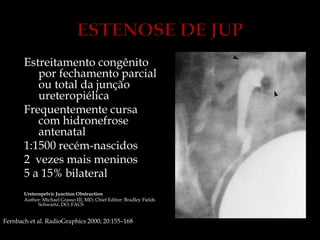 Estreitamento congênito
por fechamento parcial
ou total da junção
ureteropiélica
Frequentemente cursa
com hidronefrose
antenatal
1:1500 recém-nascidos
2 vezes mais meninos
5 a 15% bilateral
Ureteropelvic Junction Obstruction
Author: Michael Grasso III, MD; Chief Editor: Bradley Fields
Schwartz, DO, FACS
Fernbach et al. RadioGraphics 2000; 20:155–168
 