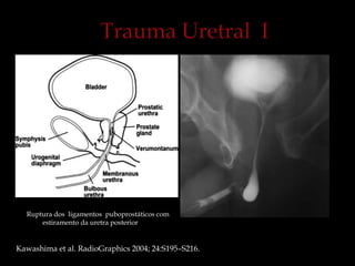 Ruptura dos ligamentos puboprostáticos com
estiramento da uretra posterior
Kawashima et al. RadioGraphics 2004; 24:S195–S216.
 