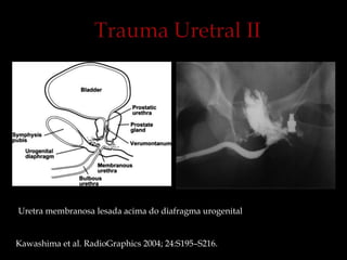 Uretra membranosa lesada acima do diafragma urogenital
Kawashima et al. RadioGraphics 2004; 24:S195–S216.
 