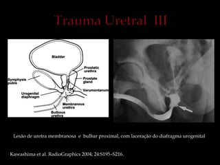 Lesão de uretra membranosa e bulbar proximal, com laceração do diafragma urogenital
Kawashima et al. RadioGraphics 2004; 24:S195–S216.
 