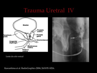 Lesão do colo vesical
Kawashima et al. RadioGraphics 2004; 24:S195–S216.
 