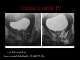 Lesão diafragma pélvico
Kawashima et al. RadioGraphics 2004; 24:S195–S216.
 