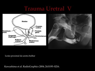 Lesão proximal da uretra bulbar
Kawashima et al. RadioGraphics 2004; 24:S195–S216.
 