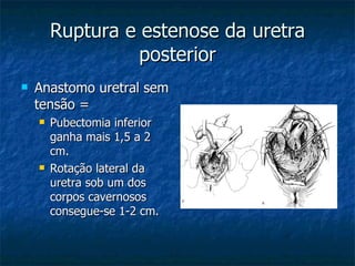 Ruptura e estenose da uretra posterior Anastomo uretral sem tensão = Pubectomia inferior ganha mais 1,5 a 2 cm. Rotação lateral da uretra sob um dos corpos cavernosos consegue-se 1-2 cm. 