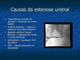 Causas da estenose uretral Traumatismo fechado do perineo = estenose da uretra bulbar Fratura da bacia = ruptura e estenose da uretra posterior Balanite xerótica (líquen fibroso) = estenose do meato e uretra pendular Iatrogênica = qualquer nível da uretra DST – menos frequente na atualidade 