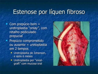 Estenose por líquen fibroso Com prepúcio bom = uretroplastia “onlay”, com retalho pediculado prepucial Prepúcio comprometido ou ausente = uretoplastia em 2 tempos  Uretroplastia de Johanson, e após 6 meses Uretroplastia por “snod-graft” com mucosa oral  