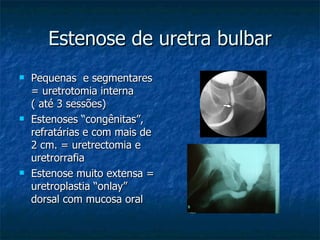 Estenose de uretra bulbar Pequenas  e segmentares = uretrotomia interna ( até 3 sessões) Estenoses “congênitas”, refratárias e com mais de 2 cm. = uretrectomia e uretrorrafia Estenose muito extensa = uretroplastia “onlay” dorsal com mucosa oral 