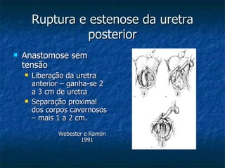 Ruptura e estenose da uretra posterior Anastomose sem tensão Liberação da uretra anterior – ganha-se 2 a 3 cm de uretra Separação proximal dos corpos cavernosos – mais 1 a 2 cm. Webester e Ramon  1991 