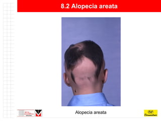 8.2 Alopecia areata Alopecia areata   