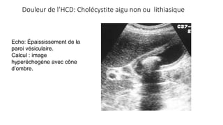 Douleur de l’HCD: Cholécystite aigu non ou lithiasique
Echo: Épaississement de la
paroi vésiculaire.
Calcul : image
hyperéchogène avec cône
d’ombre.
 