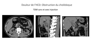 Douleur de l’HCD: Obstruction du cholédoque
TDM sans et avec injection
 