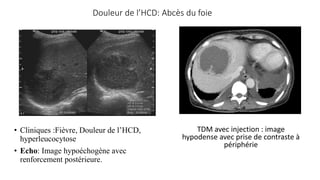 Douleur de l’HCD: Abcès du foie
• Cliniques :Fièvre, Douleur de l’HCD,
hyperleucocytose
• Echo: Image hypoéchogène avec
renforcement postérieure.
TDM avec injection : image
hypodense avec prise de contraste à
périphérie
 