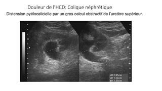 Douleur de l’HCD: Colique néphrétique
Distension pyélocalicielle par un gros calcul obstructif de l’uretère supérieur.
 