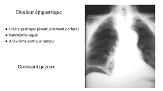 Douleur épigastrique
● Ulcère gastrique (éventuellement perforé)
● Pancréatite aiguë
● Anévrisme aortique rompu
Croissant gazeux
 