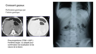 Croissant gazeux
Perforation gastrique par
l’ulcère gastrique
Pneumopéritoine (TDM > ASP ):
Fenêtres larges ou adapté pour
confirmation de localisation et de
nature de la lésion.
 