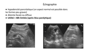 Échographie
● Hypodensité pancréatique (un aspect normal est possible dans
les formes peu graves)
● Atteinte focale ou diffuse
● Utilité < 48h limitée (après iléus paralytique)
 