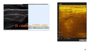 Appendicitis : US
29
 