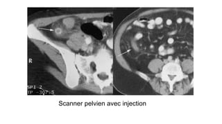 Scanner pelvien avec injection
 