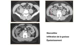 Stercolithe
Infiltration de la graisse
Épaississement
 