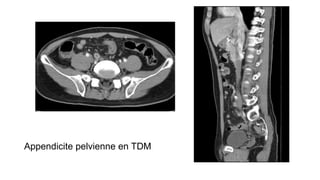 Appendicite pelvienne en TDM
 
