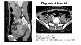 29 ans , appendicite ?
Hyperleucocytose :15000
Dia: Thrombose phlébite de la veine ovarique droite
Diagnostic différentiel
 