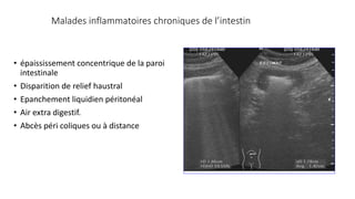 Malades inflammatoires chroniques de l’intestin
• épaississement concentrique de la paroi
intestinale
• Disparition de relief haustral
• Epanchement liquidien péritonéal
• Air extra digestif.
• Abcès péri coliques ou à distance
 
