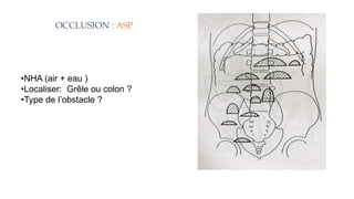 OCCLUSION : ASP
•NHA (air + eau )
•Localiser: Grêle ou colon ?
•Type de l’obstacle ?
 