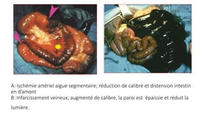 A: Ischémie artériel aigue segmentaire; réduction de calibre et distension intestin
en d’amont
B: Infarcissement veineux; augmenté de calibre, la paroi est épaissie et réduit la
lumière.
 