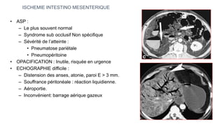 • ASP :
– Le plus souvent normal
– Syndrome sub occlusif Non spécifique
– Sévérité de l’atteinte :
• Pneumatose pariétale
• Pneumopéritoine
• OPACIFICATION : Inutile, risquée en urgence
• ECHOGRAPHIE difficile :
– Distension des anses, atonie, paroi E > 3 mm.
– Souffrance péritonéale : réaction liquidienne.
– Aéroportie.
– Inconvénient: barrage aérique gazeux
ISCHEMIE INTESTINO MESENTERIQUE
 