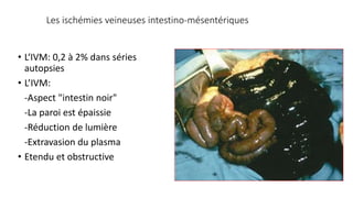 Les ischémies veineuses intestino-mésentériques
• L‘IVM: 0,2 à 2% dans séries
autopsies
• L’IVM:
-Aspect "intestin noir"
-La paroi est épaissie
-Réduction de lumière
-Extravasion du plasma
• Etendu et obstructive
 