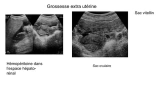 Grossesse extra utérine
Sac ovulaire
Hémopéritoine dans
l’espace hépato-
rénal
Sac vitellin
 