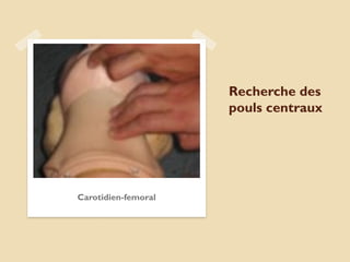 Recherche des
pouls centraux
Carotidien-femoral
 