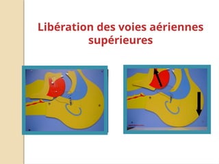 Libération des voies aériennes
supérieures
 