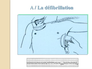 A / La défibrillation
 
