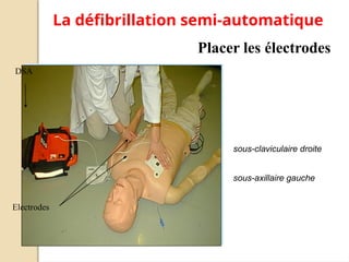 Placer les électrodes
DSA
Electrodes
La défibrillation semi-automatique
sous-claviculaire droite
sous-axillaire gauche
 