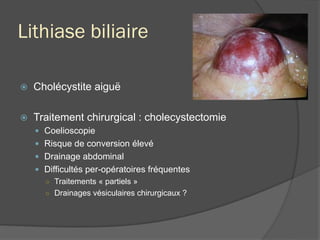 Lithiase biliaire
ž  Cholécystite aiguë
ž  Traitement chirurgical : cholecystectomie
—  Coelioscopie
—  Risque de conversion élevé
—  Drainage abdominal
—  Difficultés per-opératoires fréquentes
○  Traitements « partiels »
○  Drainages vésiculaires chirurgicaux ?
 