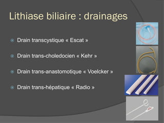 Lithiase biliaire : drainages
ž  Drain transcystique « Escat »
ž  Drain trans-choledocien « Kehr »
ž  Drain trans-anastomotique « Voelcker »
ž  Drain trans-hépatique « Radio »
 