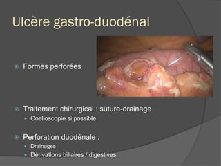 Ulcère gastro-duodénal
ž  Formes perforées
ž  Traitement chirurgical : suture-drainage
—  Coelioscopie si possible
ž  Perforation duodénale :
—  Drainages
—  Dérivations biliaires / digestives
 