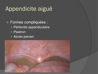 Appendicite aiguë
ž  Formes compliquées :
—  Péritonite appendiculaire
—  Plastron
—  Abcès pelvien
ž  Complications post-opératoires :
—  Abcès Douglas / à distance
—  Lâchage du moignon : rarissime..
—  Douleur du 5e jour ?
 