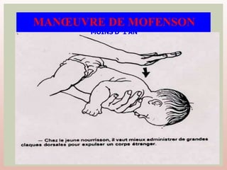 MANŒUVRE DE MOFENSON
MOINS D’ 1 AN
 