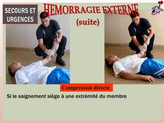 Compression directe
Si le saignement siège à une extrémité du membre
 