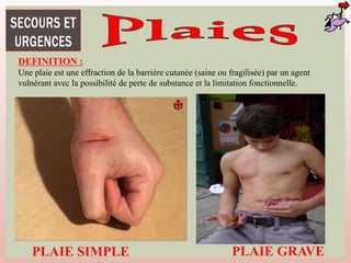 DEFINITION :
Une plaie est une effraction de la barrière cutanée (saine ou fragilisée) par un agent
vulnérant avec la possibilité de perte de substance et la limitation fonctionnelle.
PLAIE SIMPLE PLAIE GRAVE
 
