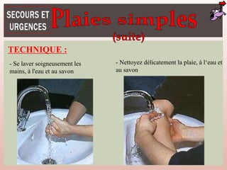 TECHNIQUE :
- Se laver soigneusement les
mains, à l'eau et au savon
- Nettoyez délicatement la plaie, à l‘eau et
au savon
 