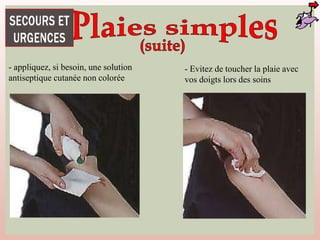 - appliquez, si besoin, une solution
antiseptique cutanée non colorée
- Evitez de toucher la plaie avec
vos doigts lors des soins
 