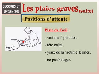 Positions d’attente
Plaie de l’œil :
- victime à plat dos,
- tête calée,
- yeux de la victime fermés,
- ne pas bouger.
 
