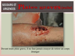 Devant toute plaie grave, il ne faut jamais essayer de retirer un corps
étranger
 