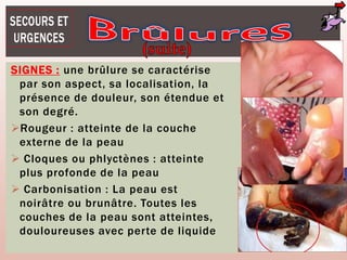SIGNES : une brûlure se caractérise
par son aspect, sa localisation, la
présence de douleur, son étendue et
son degré.
Rougeur : atteinte de la couche
externe de la peau
 Cloques ou phlyctènes : atteinte
plus profonde de la peau
 Carbonisation : La peau est
noirâtre ou brunâtre. Toutes les
couches de la peau sont atteintes,
douloureuses avec perte de liquide
 