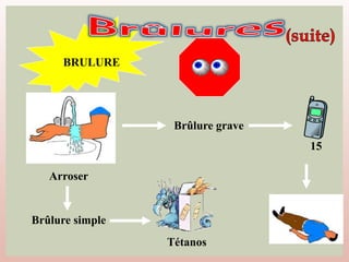 BRULURE
Brûlure grave
Arroser
Tétanos
Brûlure simple
15
 